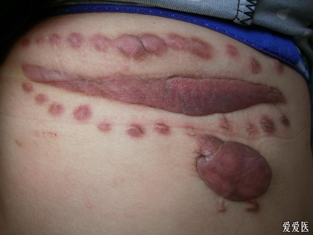 瘢痕疙瘩 - 皮肤及性传播疾病讨论版 - 爱爱医医学论坛
