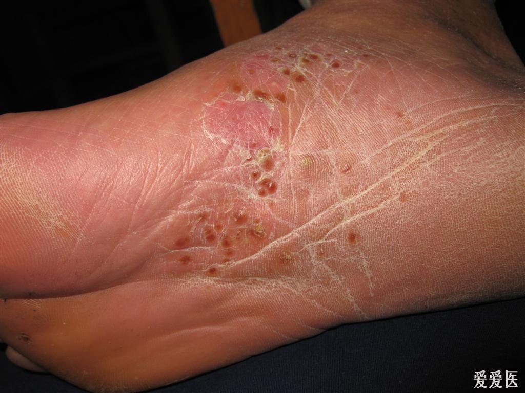 看图识病-------掌跖脓疱病