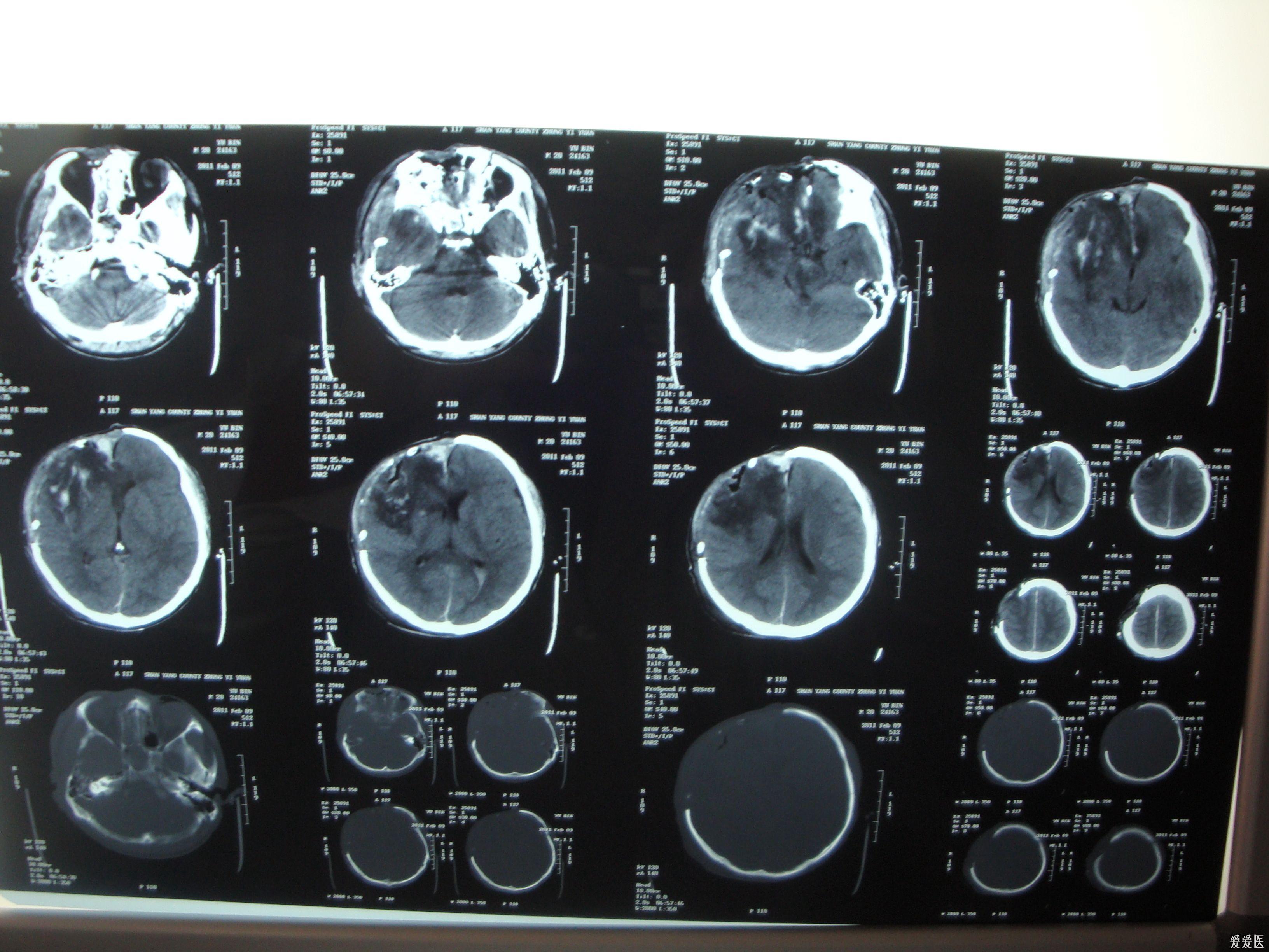 急性重型颅脑损伤图片图片