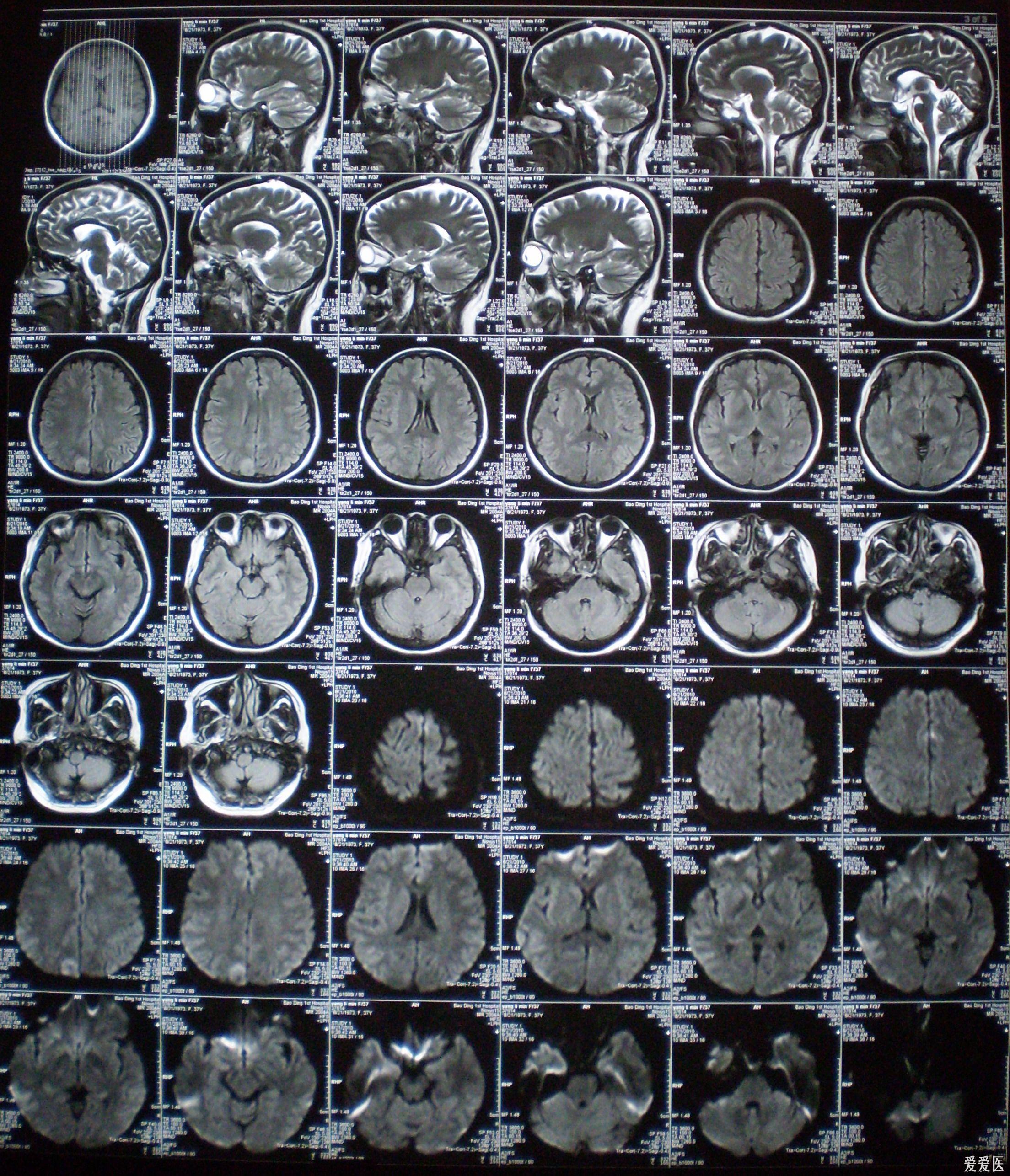 脑部肿瘤核磁共振照片图片