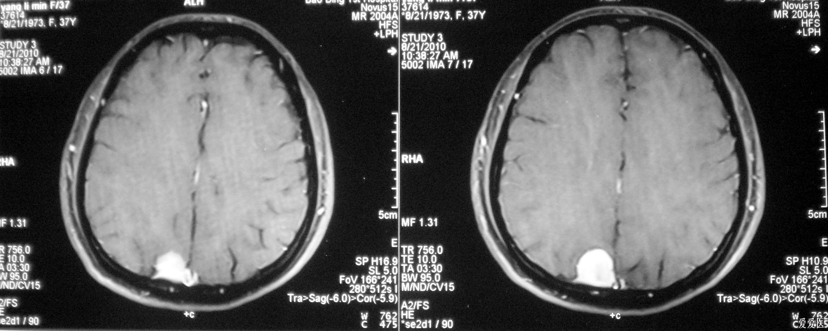 矢状窦旁多发占位脑膜瘤