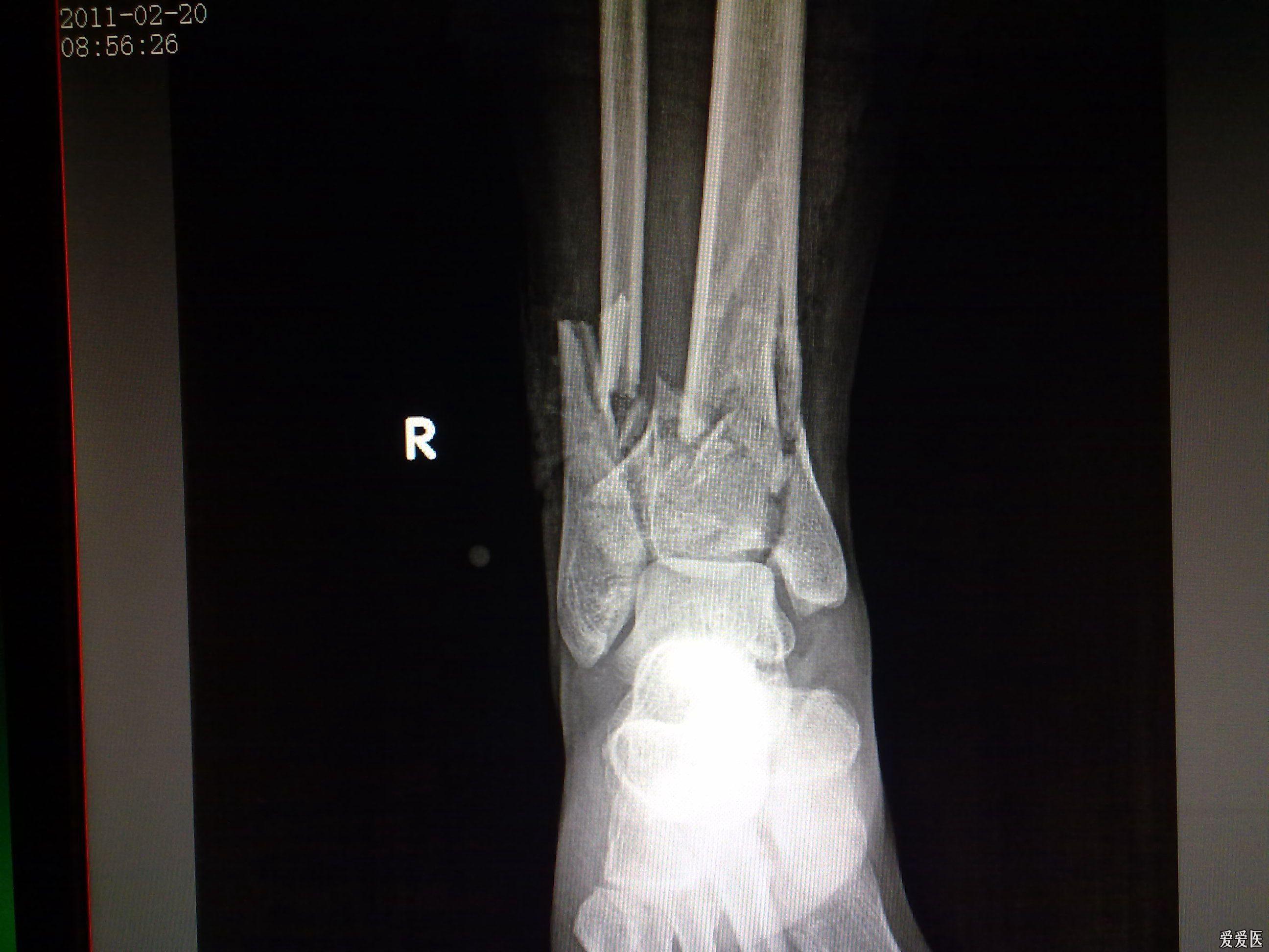 看看这个pilon骨折怎么治疗