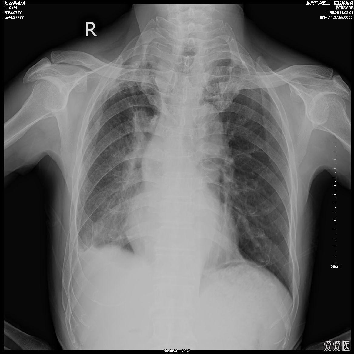 胸片2 - 醫學影像學討論版 - 愛愛醫醫學論壇