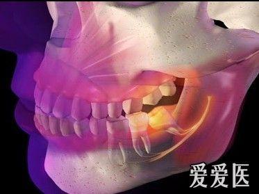 下頜骨3d照片