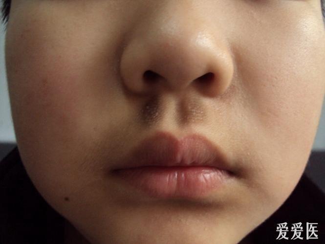 看图识病摩擦性黑变病