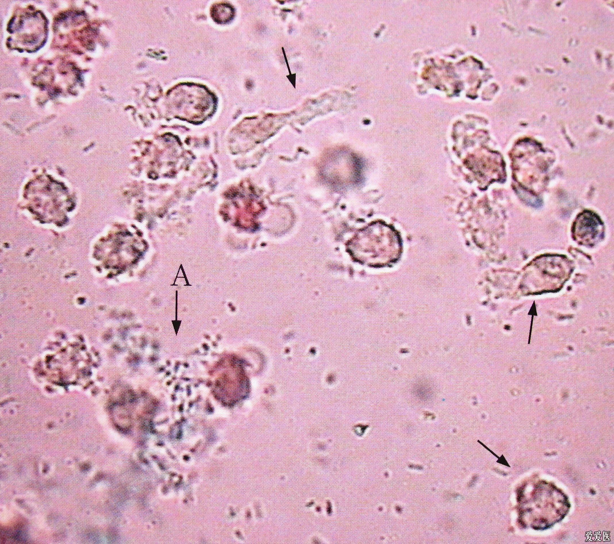 显微镜下的尿液图片
