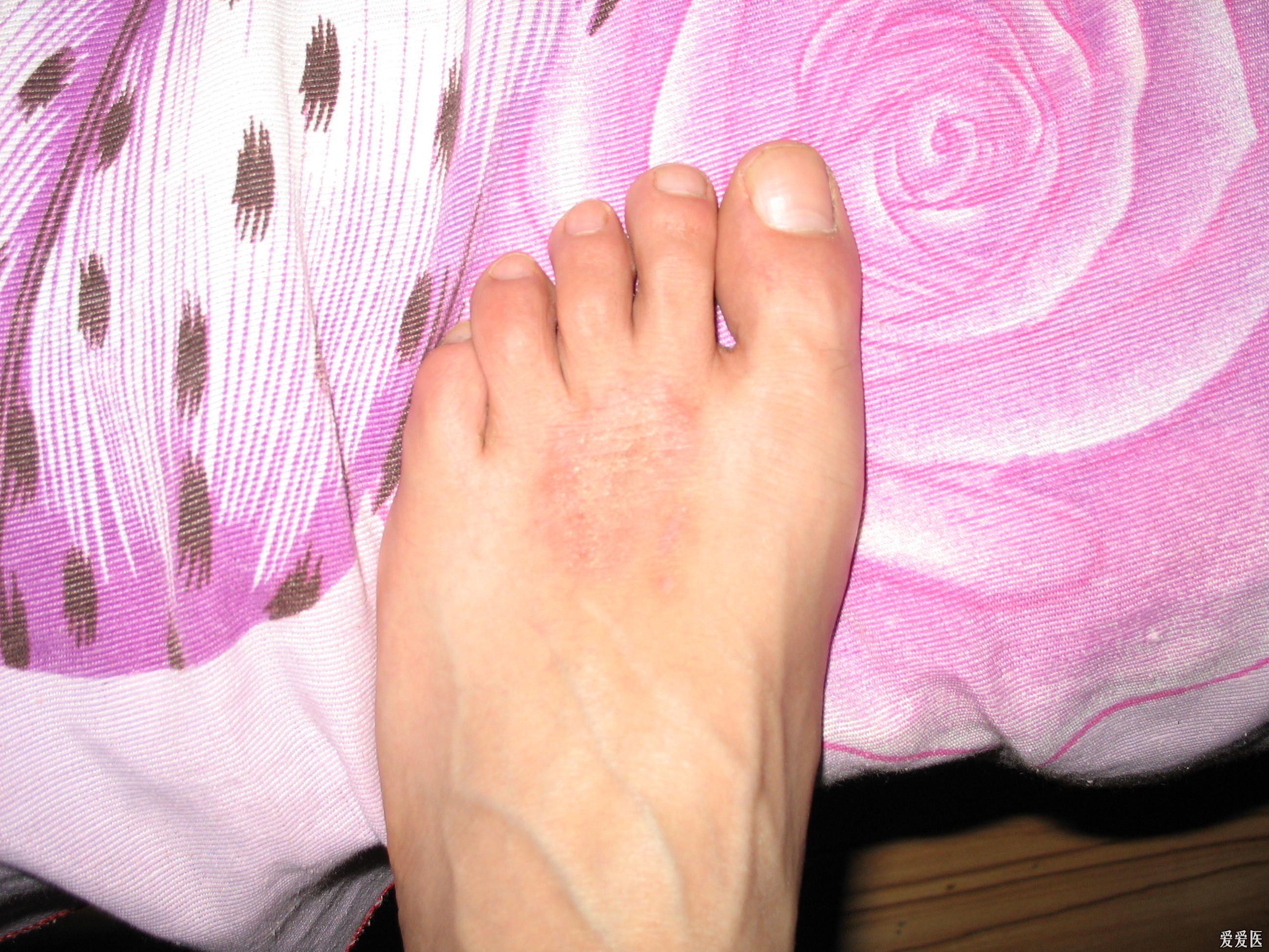 病案讨论求手足湿疹中医治疗方法