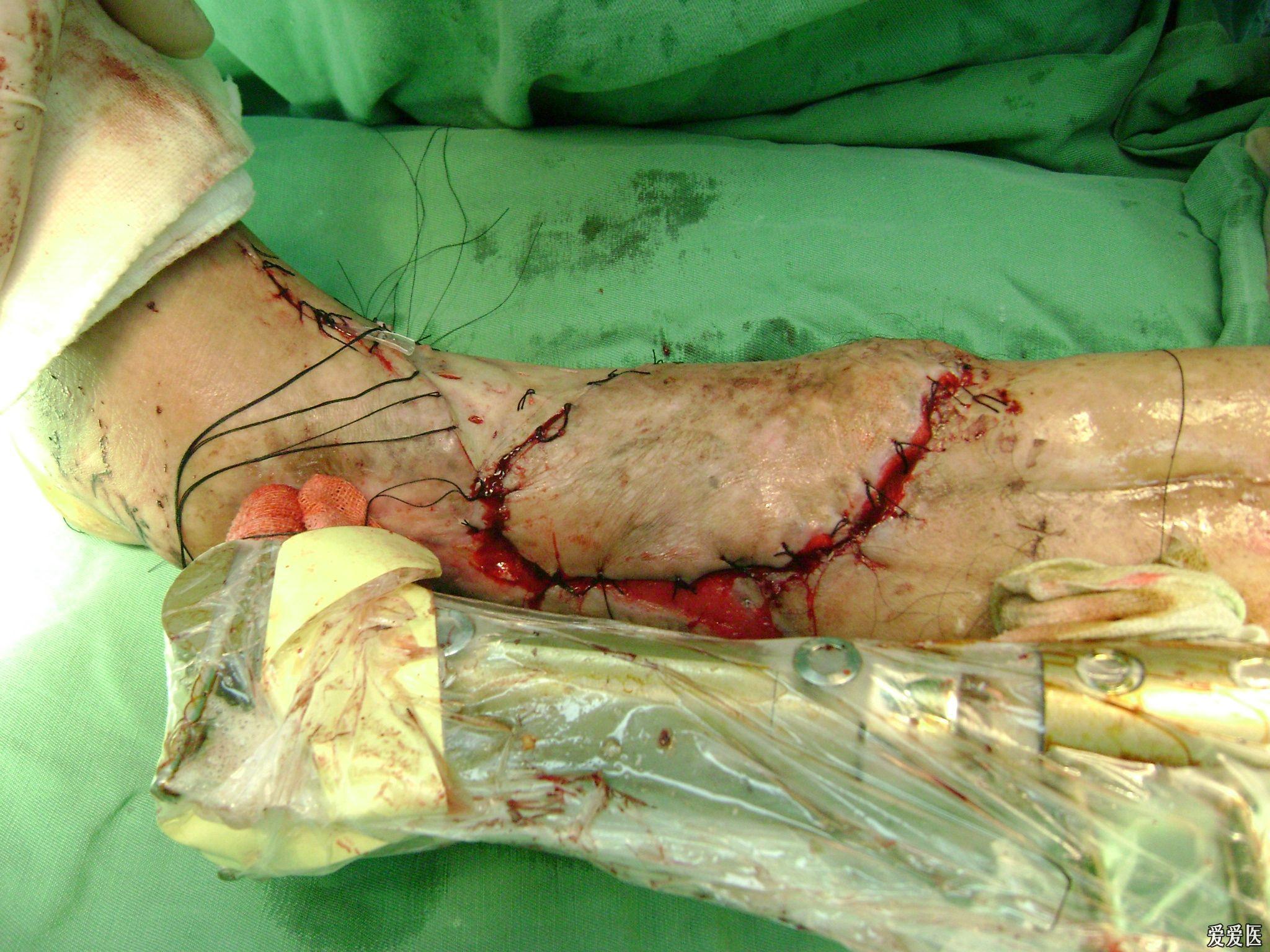 请教大家什么原因动脉危象还是筋脉危象