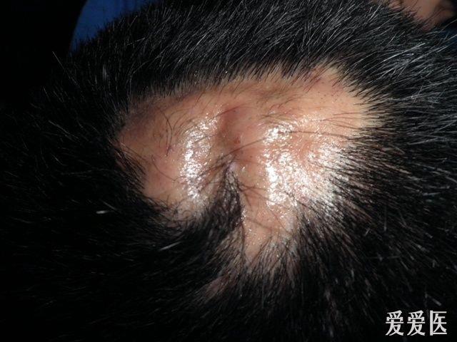 系列皮肤病穿掘脓肿性毛囊及毛囊周围炎