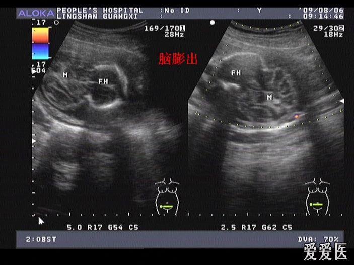 宝宝脑膜膨出图片图片