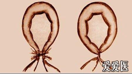 闭袢性肠梗阻的影像学表现