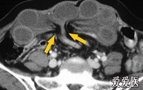 闭袢性肠梗阻的影像学表现 普外科讨论版 爱爱医医学论坛