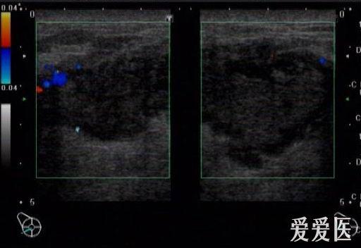 化脓性乳腺炎超声图片图片