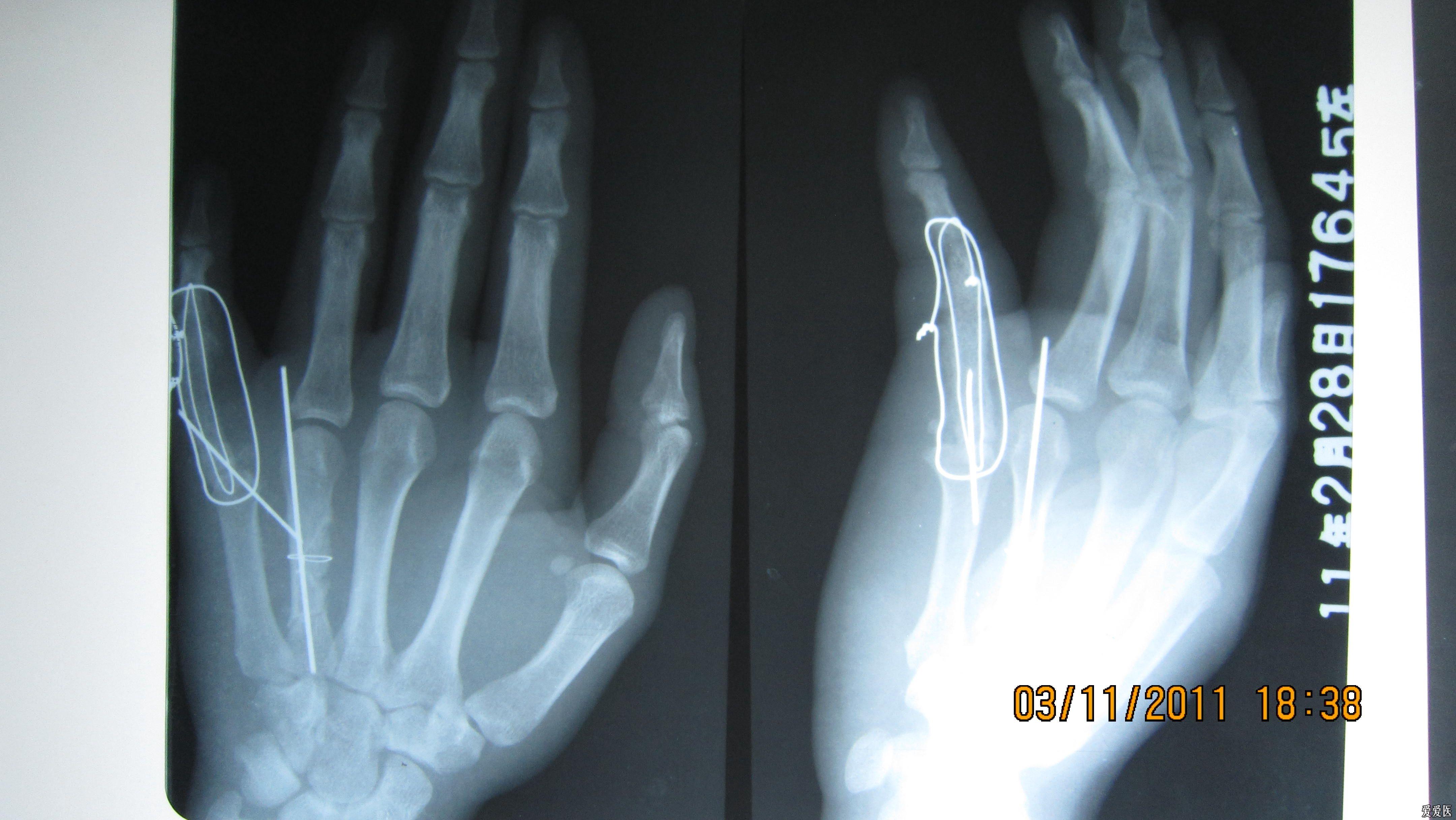 左手小指疼痛1年