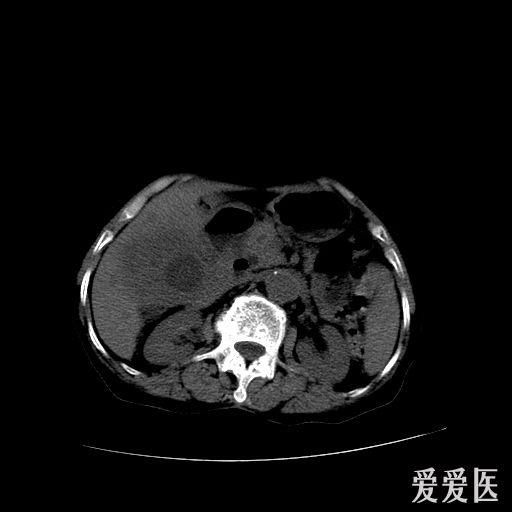 85歲老人的膽囊ctmr幫忙看下有圖片資料