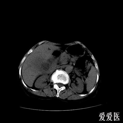 85歲老人的膽囊ctmr幫忙看下有圖片資料