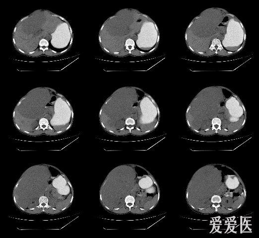 直肠癌手术后ct图片
