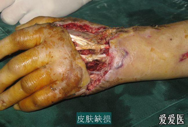 红旗型骨间背皮瓣