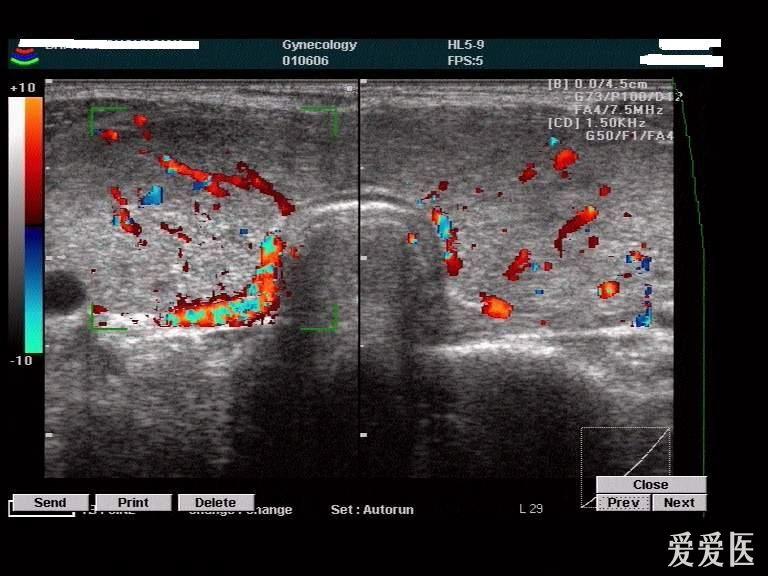 甲亢- 超声医学讨论版 - 爱爱医医学论坛