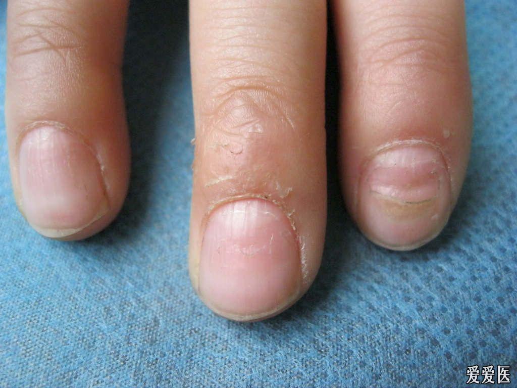 皮肌炎指甲表现图片图片