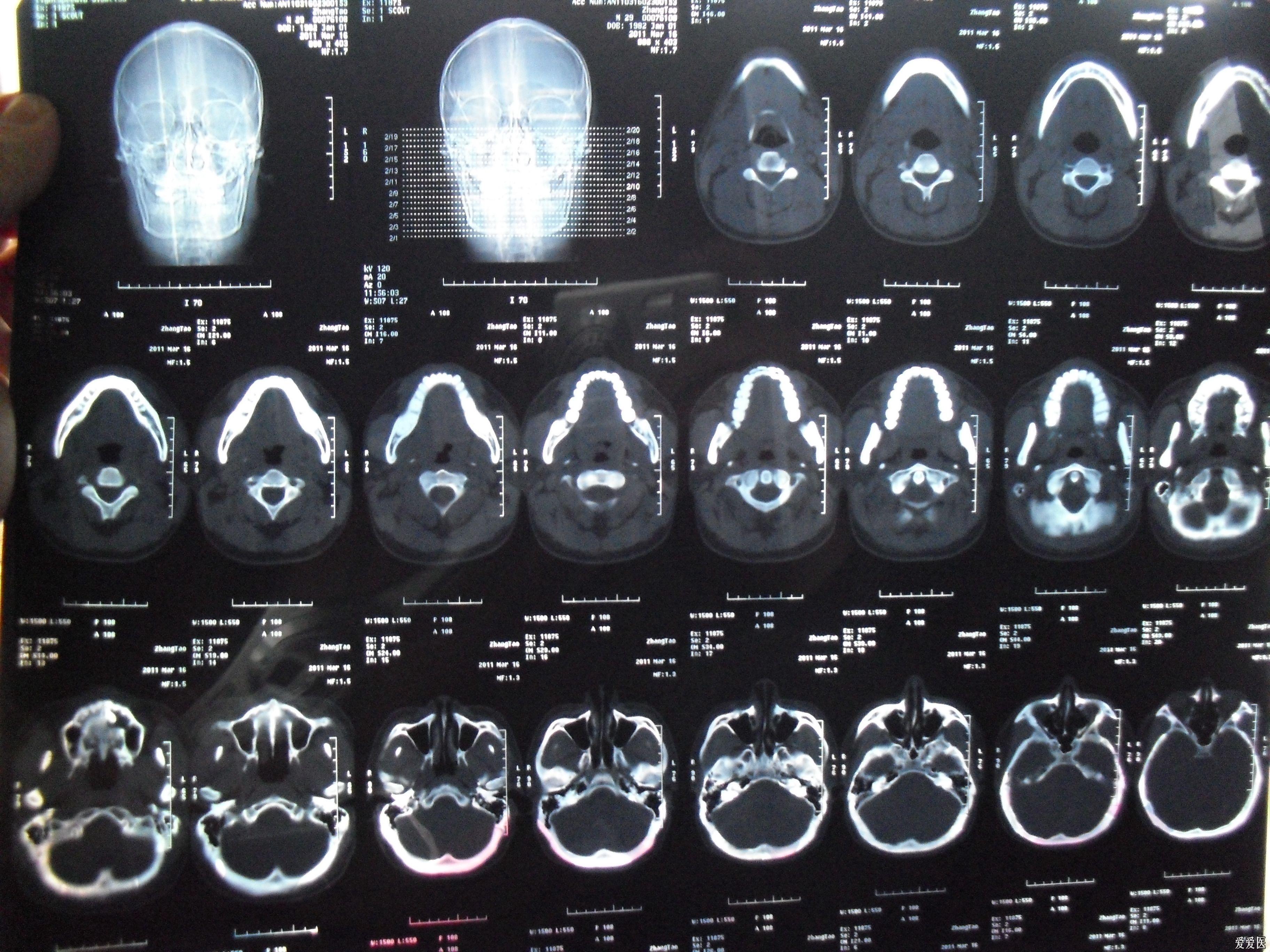 上颌含牙囊肿,跪求医生给意见或是病友探讨