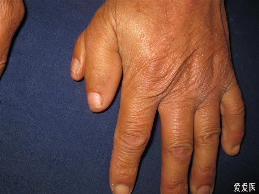 看图识病--------多指症