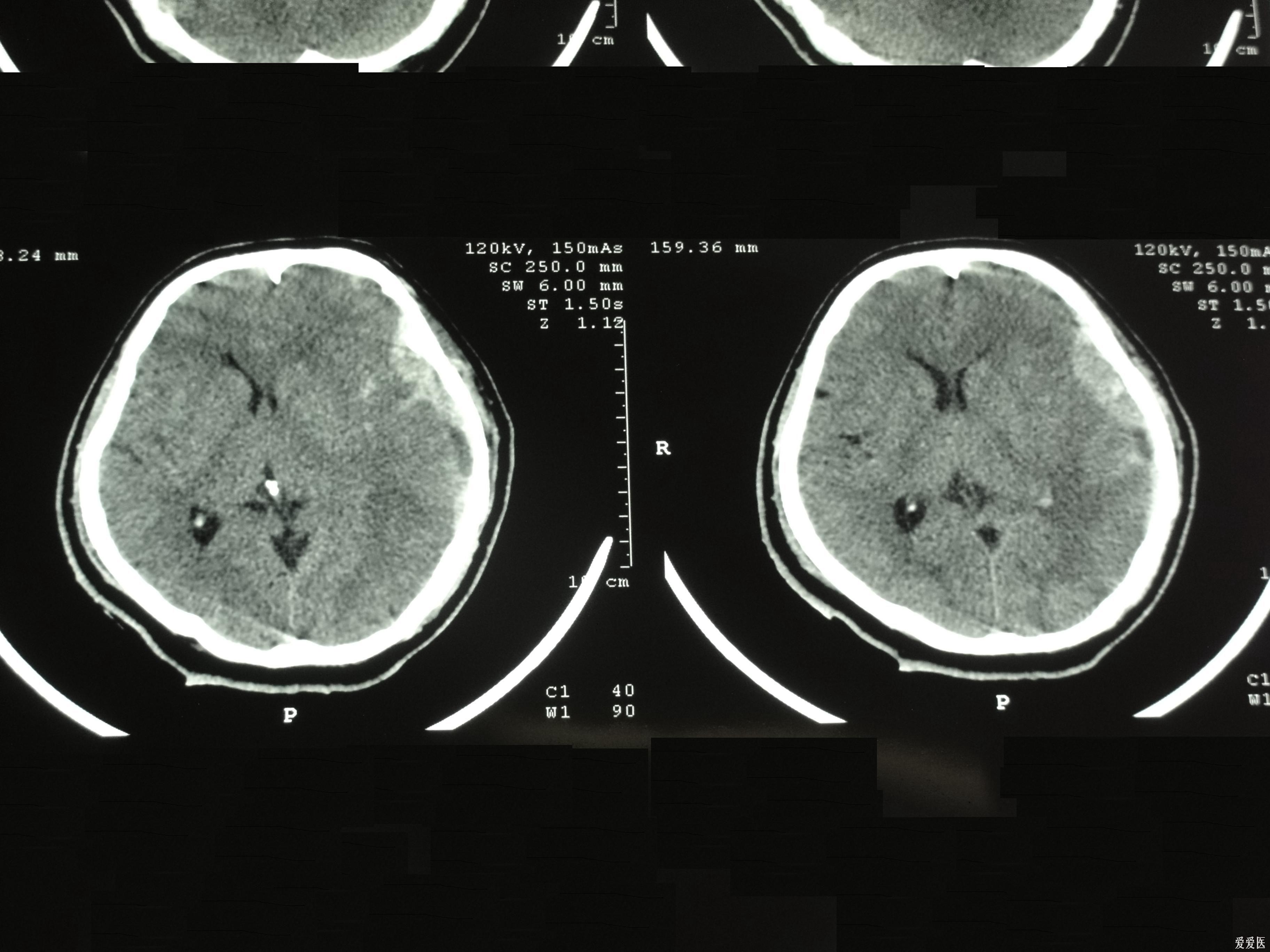 大家来看看考虑硬膜外血肿