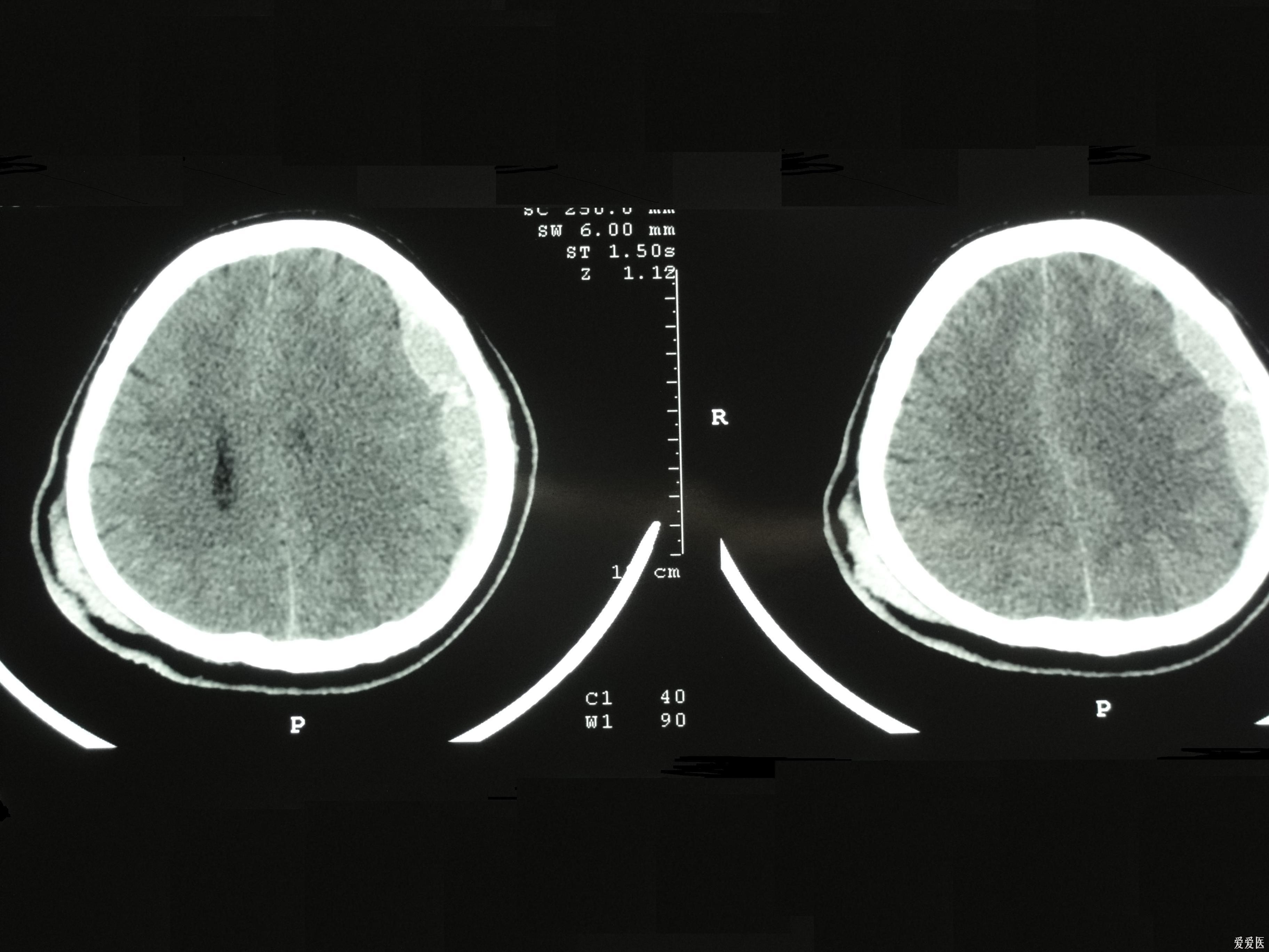 大家来看看考虑硬膜外血肿
