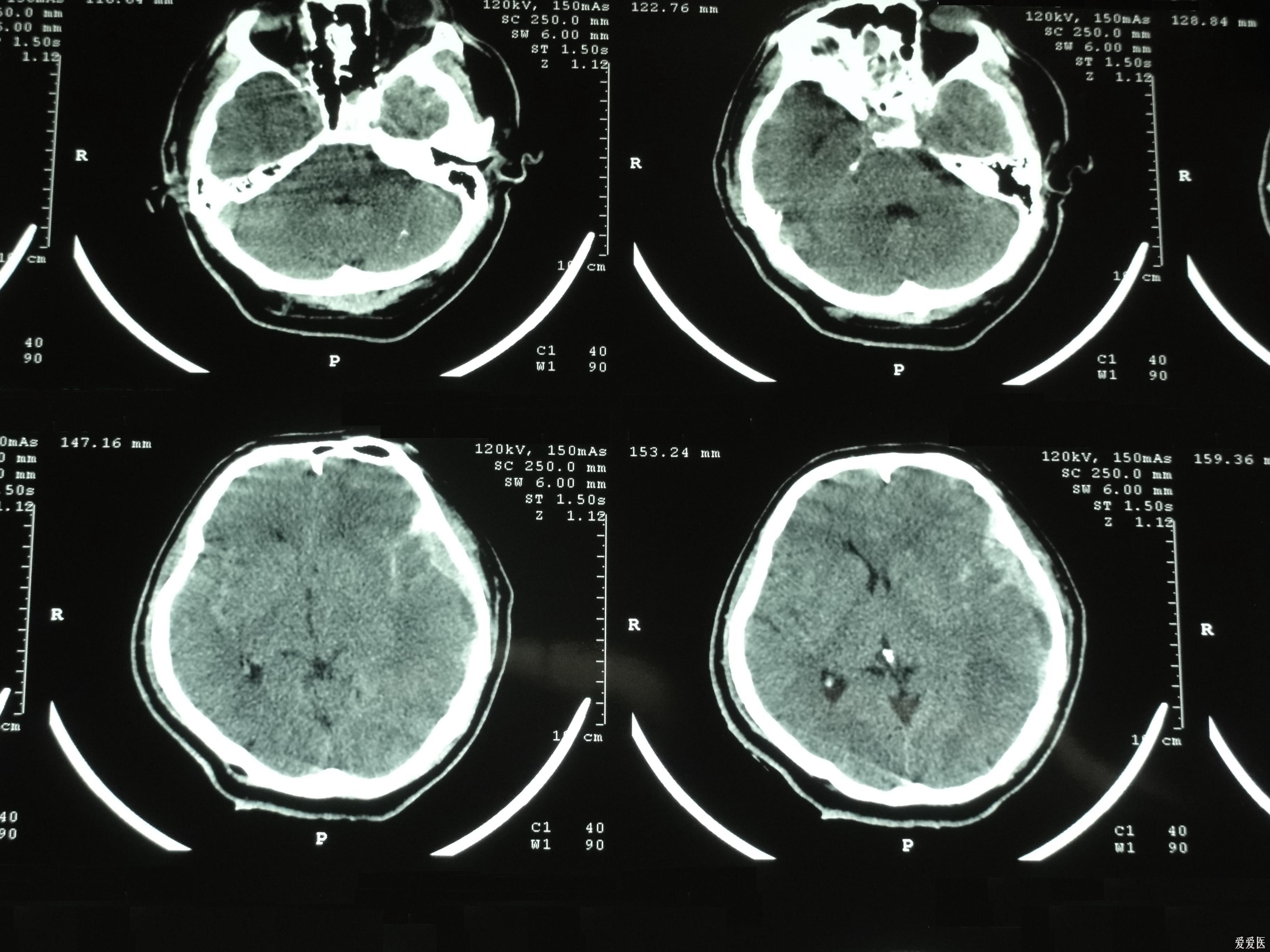 大家来看看考虑硬膜外血肿