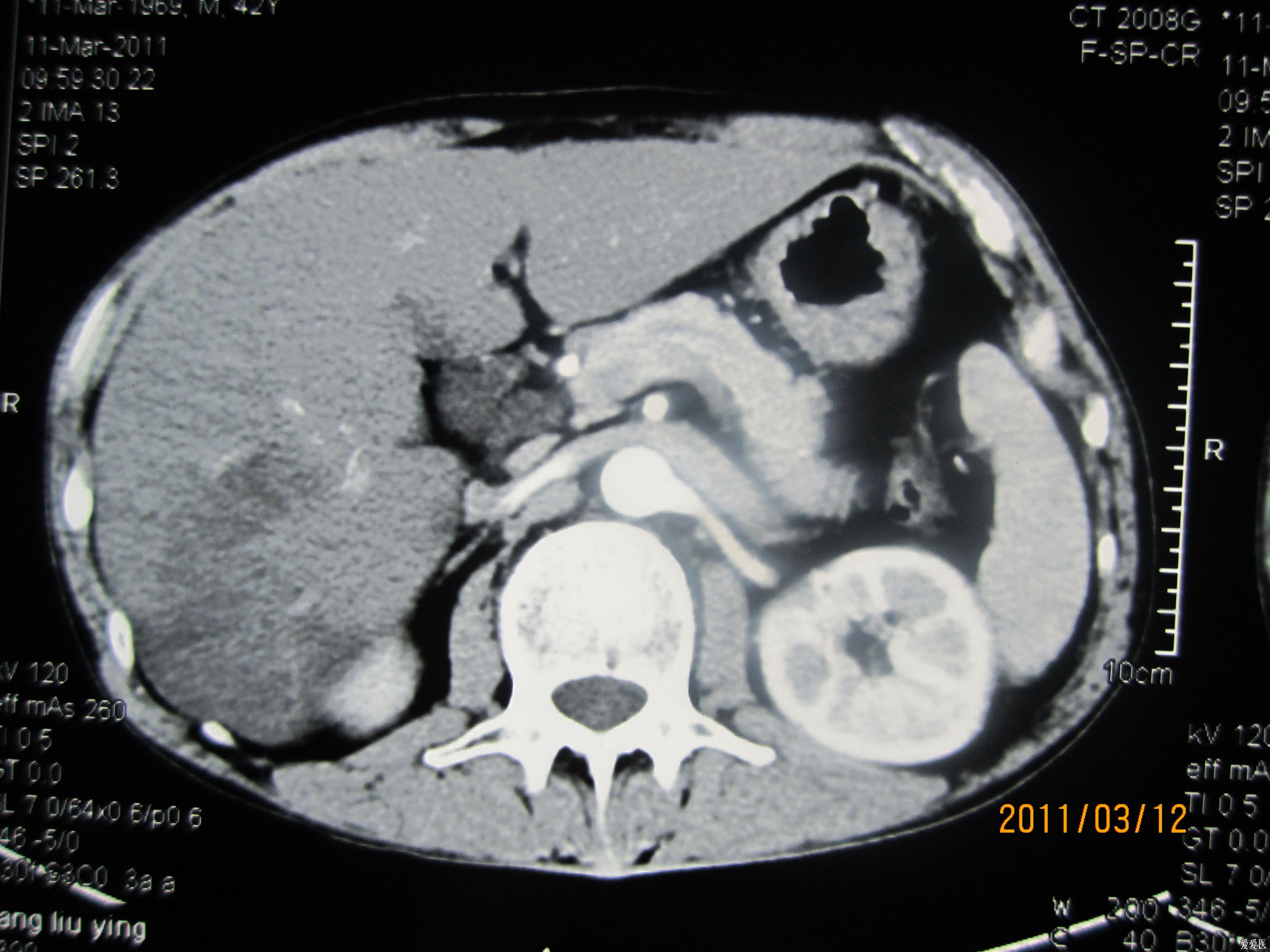 肝肿瘤ct显示图片图片