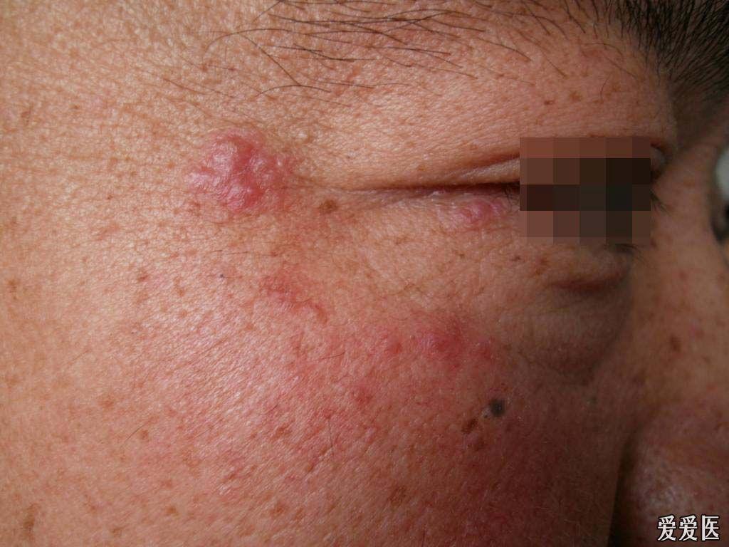 有奖猜答(3):公布答案--颜面播散性粟粒性狼疮(病理证实)