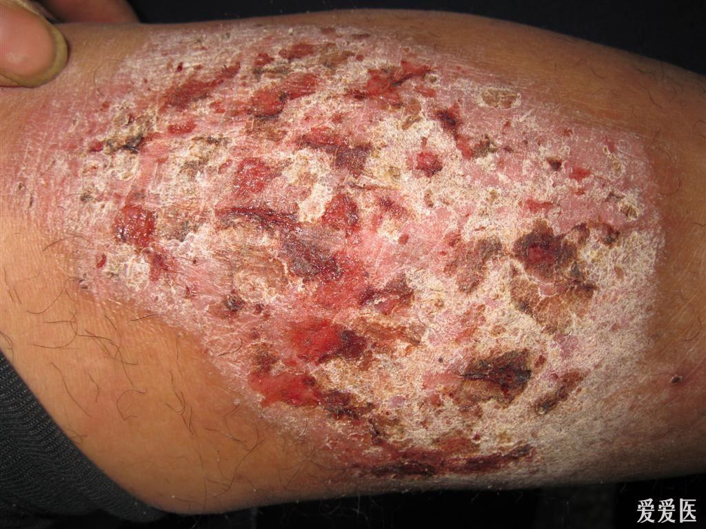 慢性皮炎湿疹症状图片图片