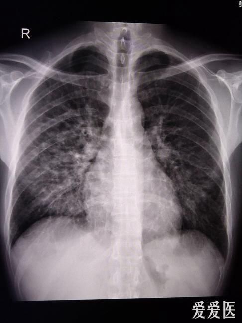 肺部x线ct片