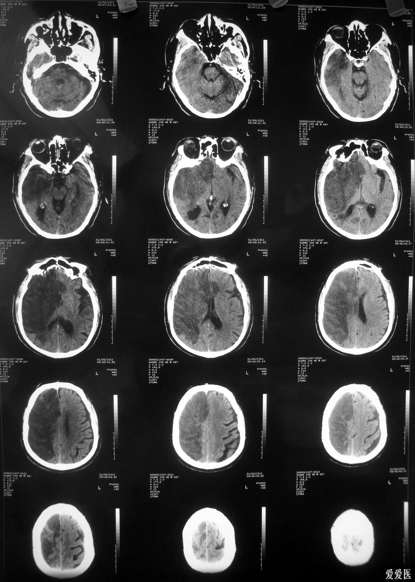 大面积脑梗塞后硬膜下积液一例四个月后并发慢性硬膜下血肿请看14楼