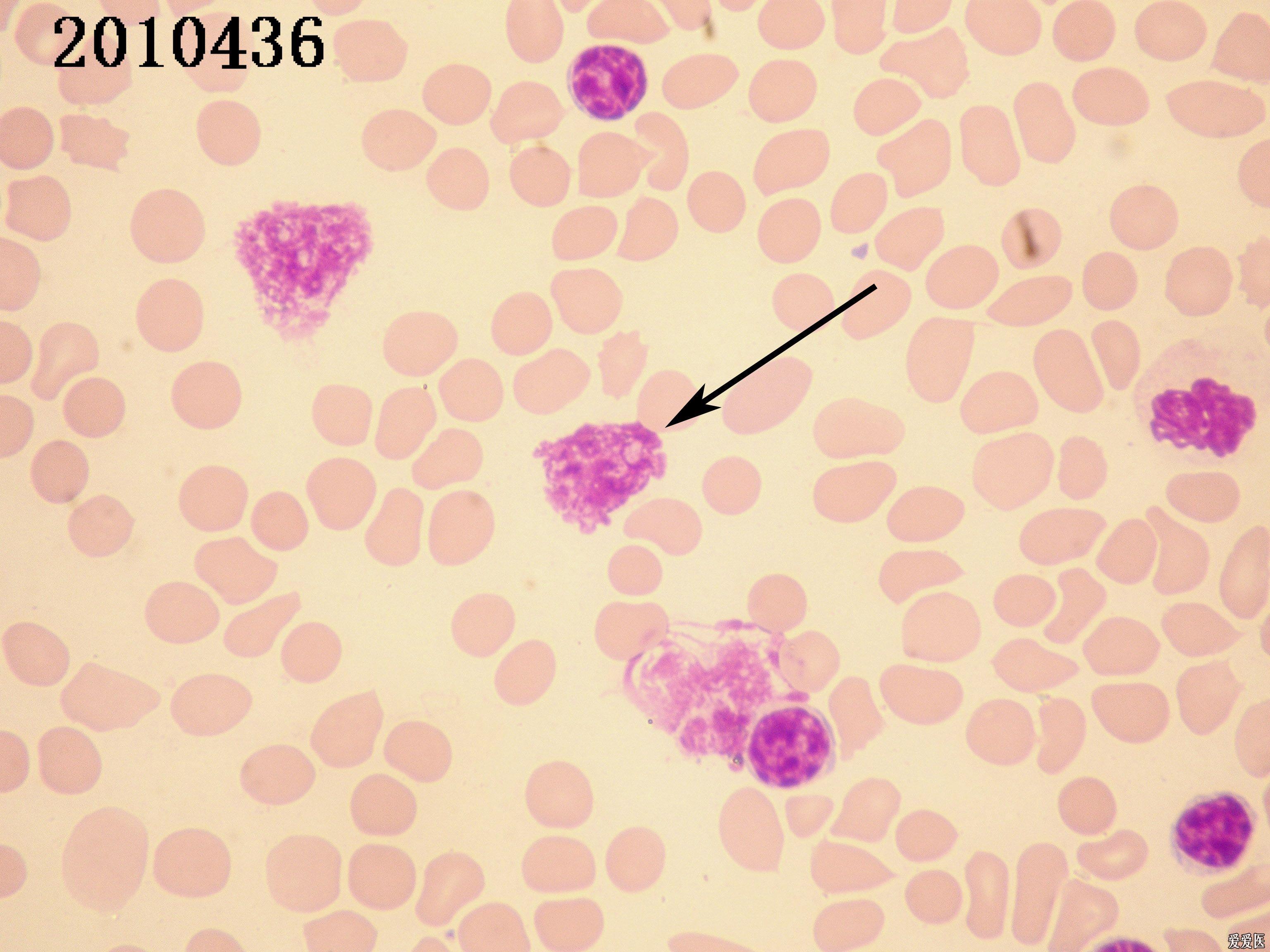 上海细胞形态学第二次室间质控 - 检验医学讨论版 - 爱爱医医学论坛