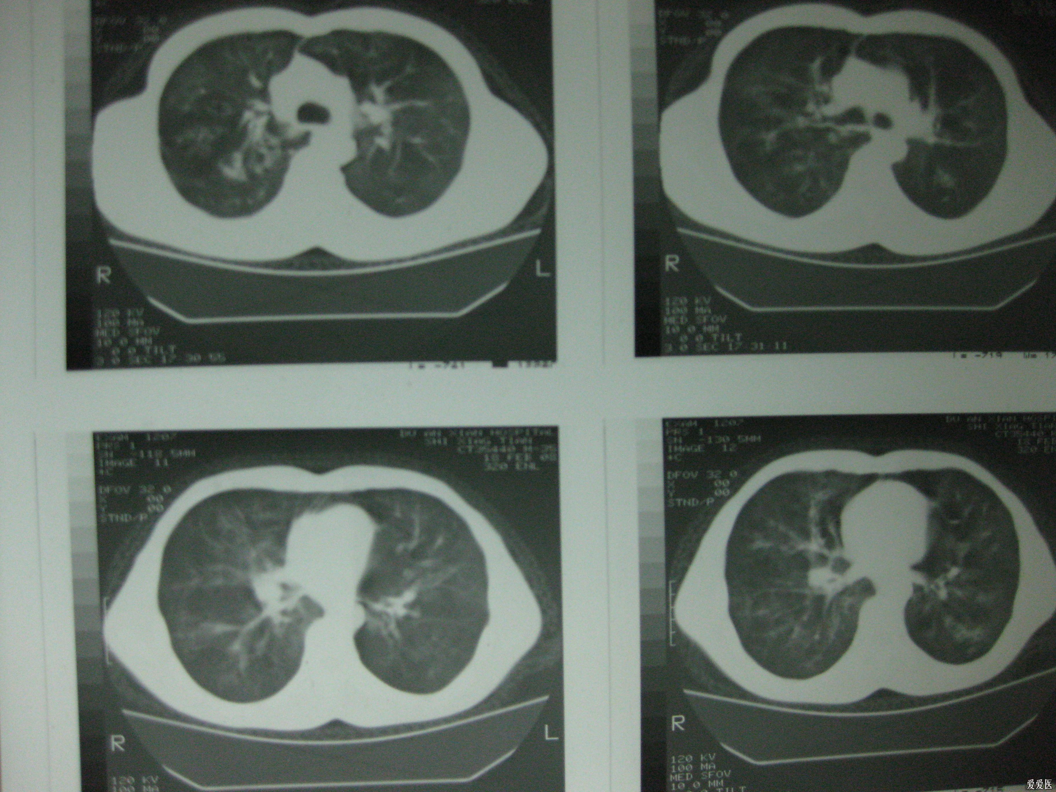 肺实质结节或肿块病灶，53张影像汇集！│以影识病_肺实质结节_肿块_影像_医脉通