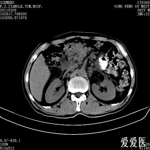 幫忙看看這個ct片有沒有腹膜後淋巴結