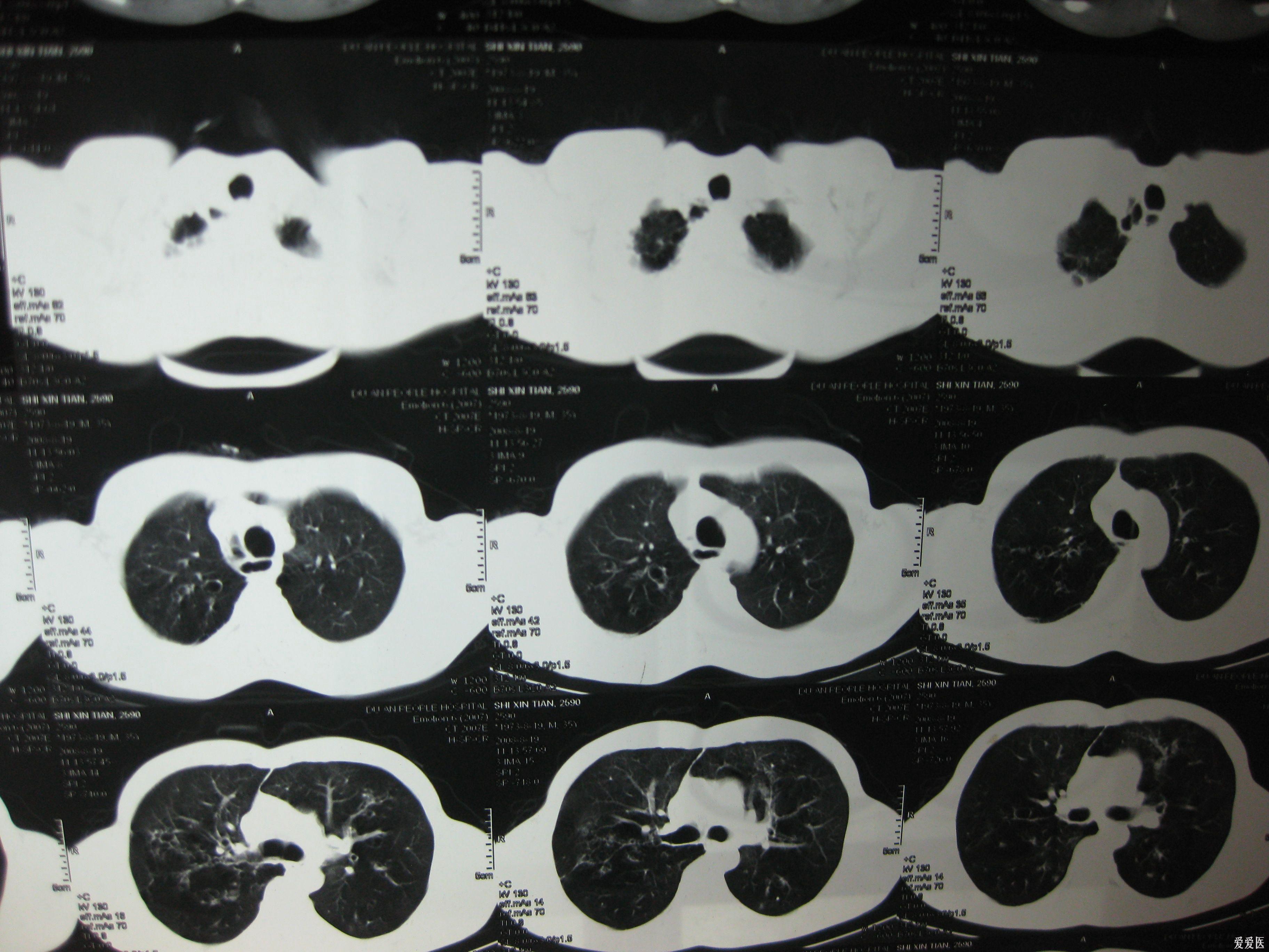 (双肺ct 医学影像学讨论版 爱爱医医学论坛