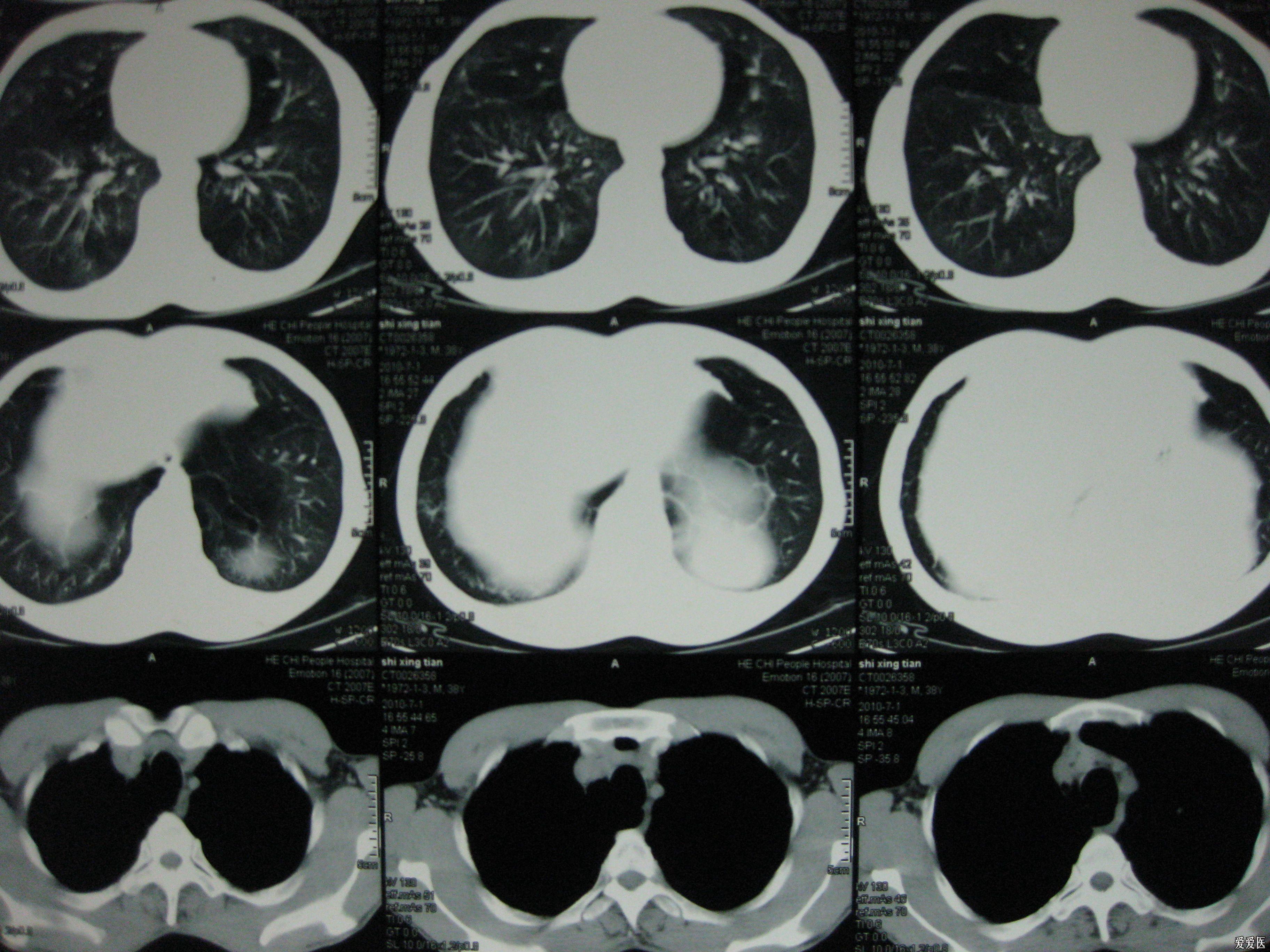 這個病考慮什麼雙肺ct