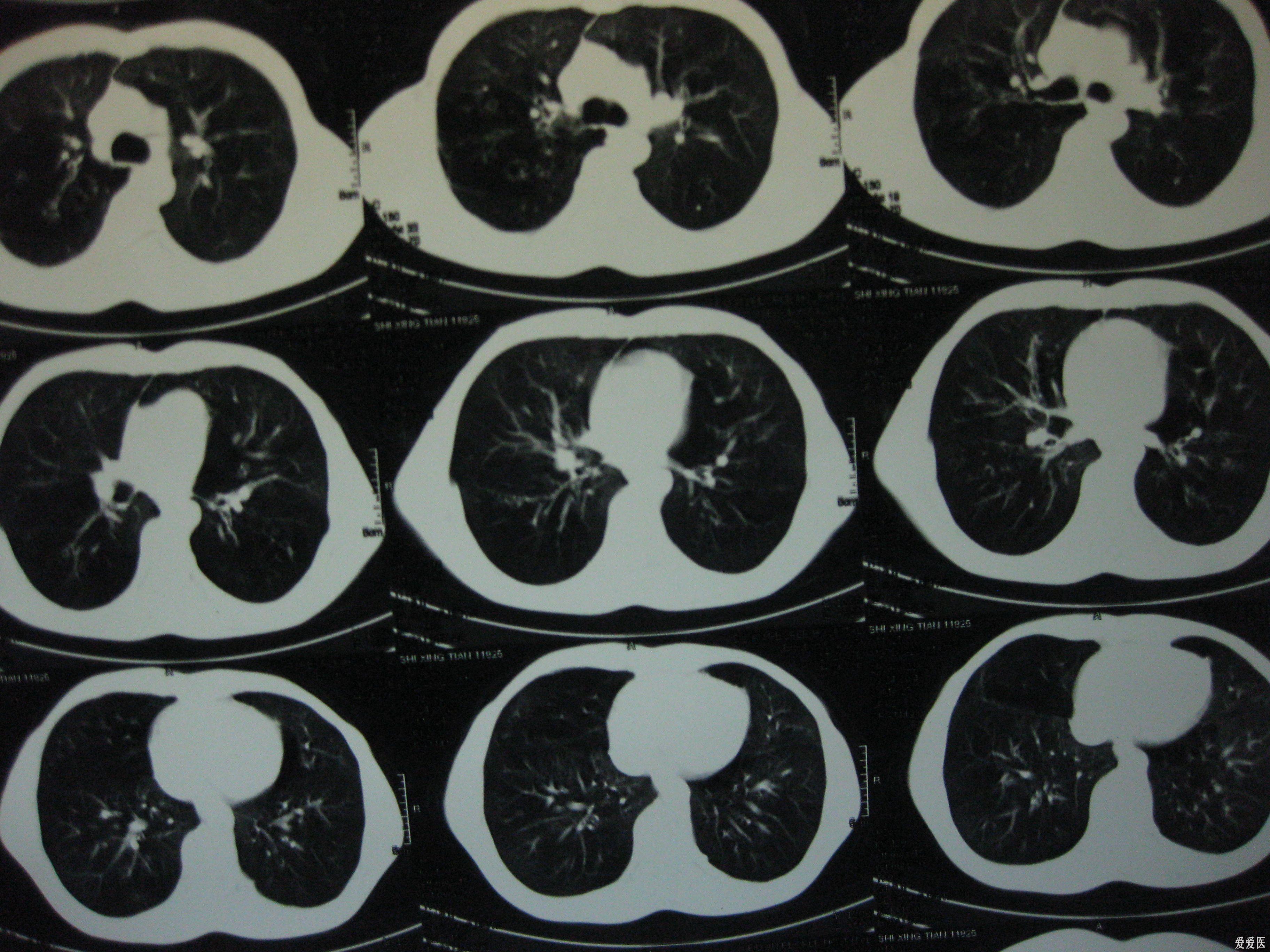 這個病考慮什麼雙肺ct