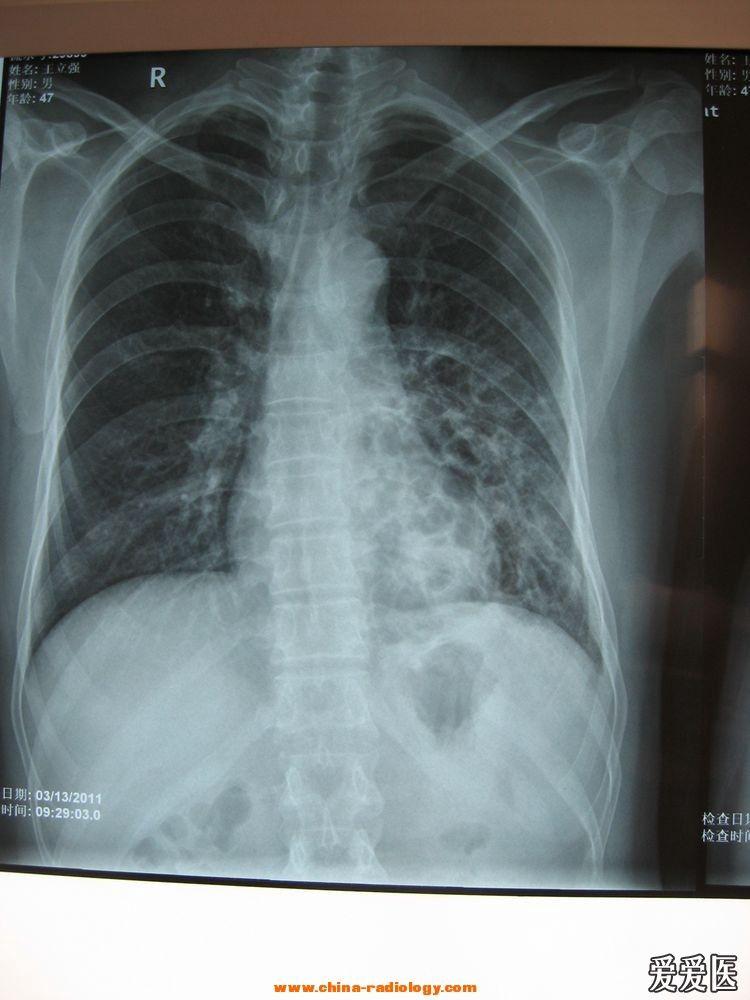 支气管扩张的x线图片图片