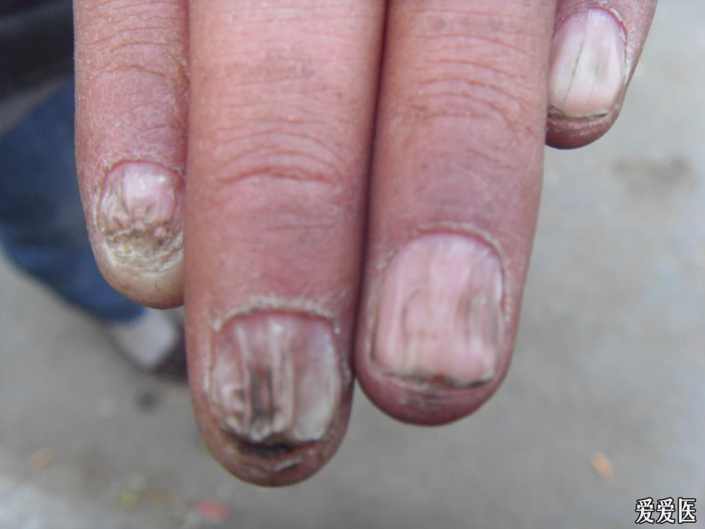 指甲病变的各种图片图片