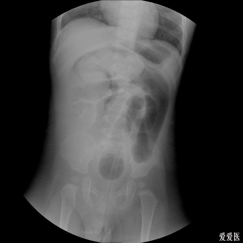肠套叠x线典型征象图片