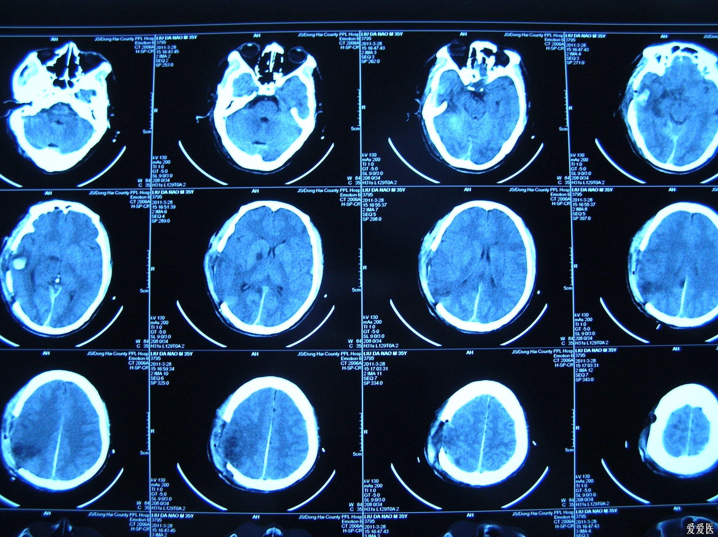 一例脑疝患者术后脑梗塞