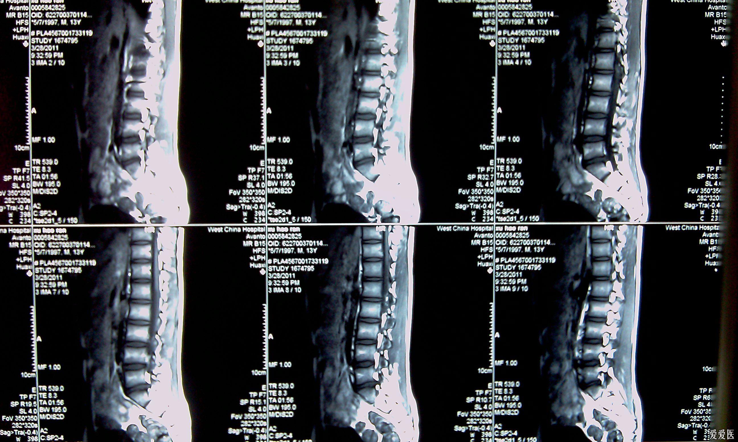  椎体后缘离断症分型及其手术治疗  椎体后缘离断症