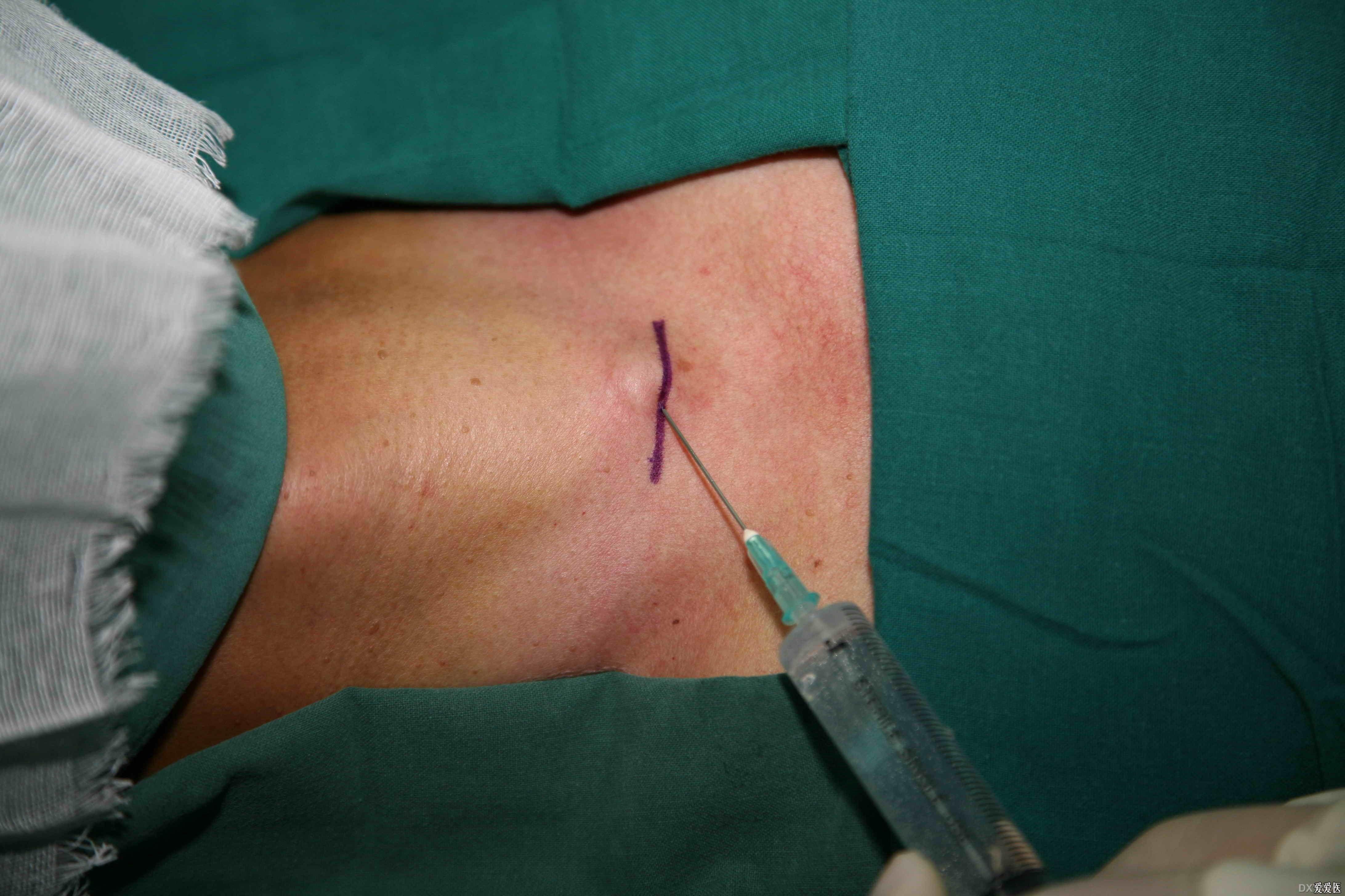 求气管切开术横切口的图谱