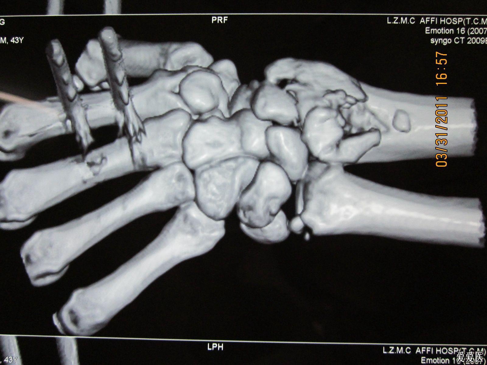 手腕豆状骨骨折图片