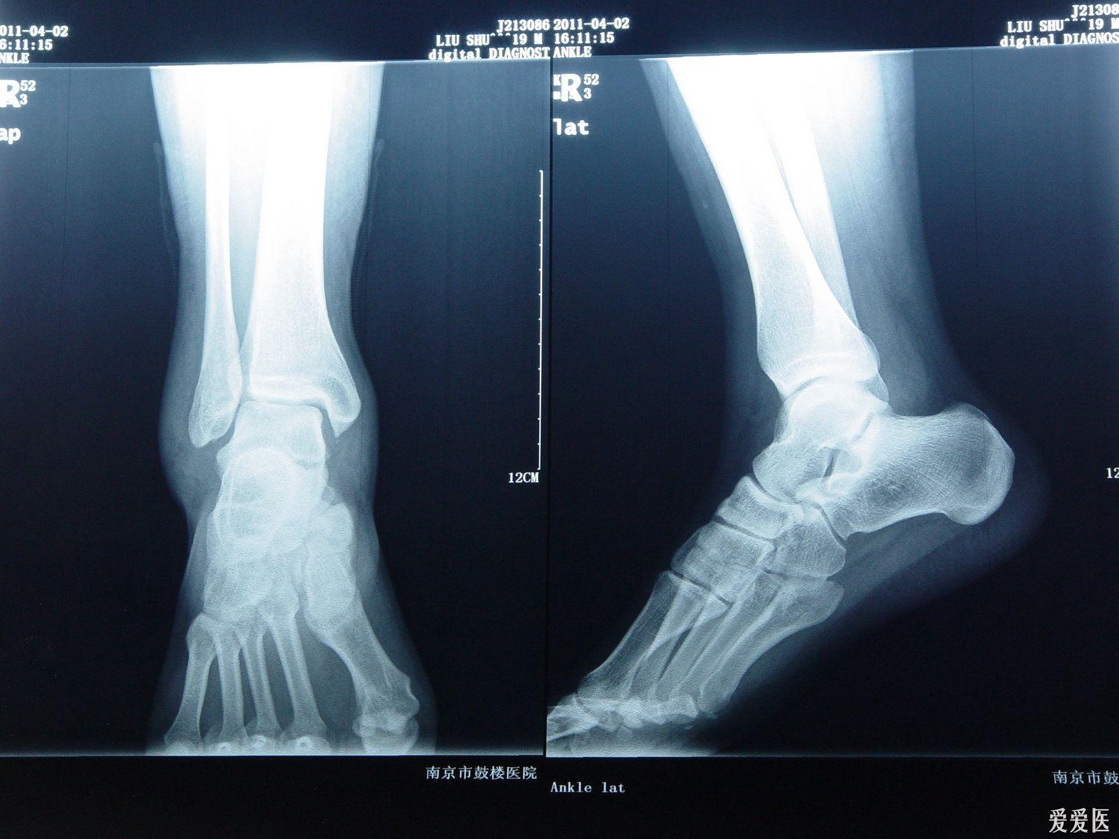 正常踝关节x光片图片