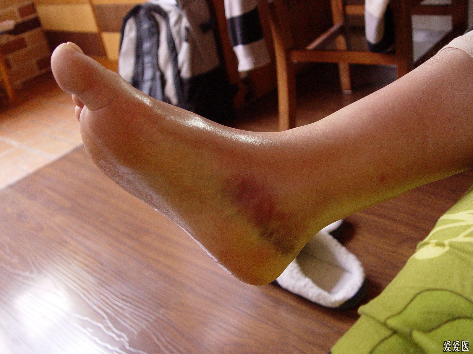 诊断求助18岁高三学生高考临近打球右踝受伤问题很严重吗