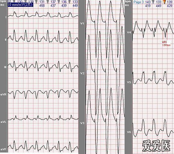 这幅图是室速还是室上速伴左束支型差传